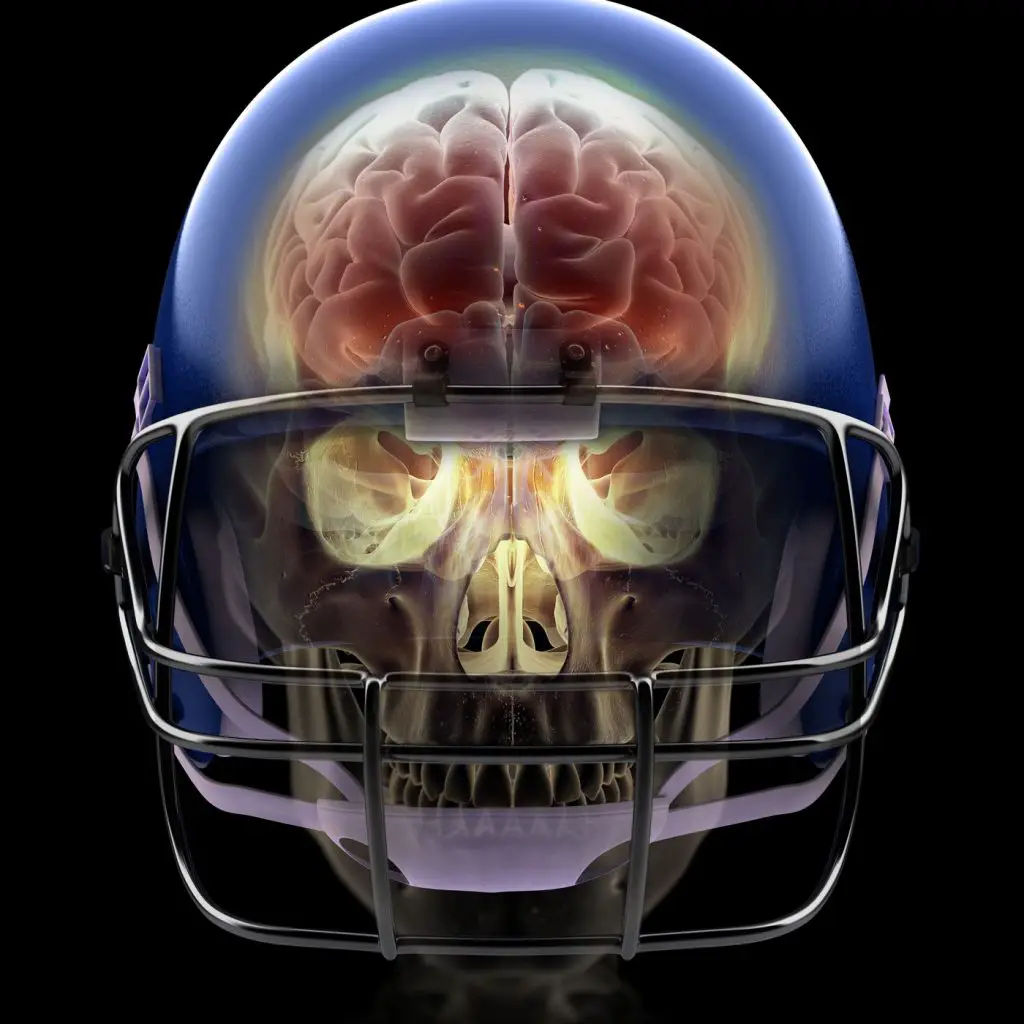 X-Ray image of skull in NFL helmets showing Brain Injuries
